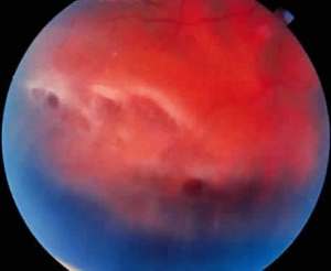 "... the patient had multiple retinal breaks and subsequent detachments, he was rushed over to ophthalmology to receive immediate surgical laser treatment to prevent a full-on retinal detachment..."